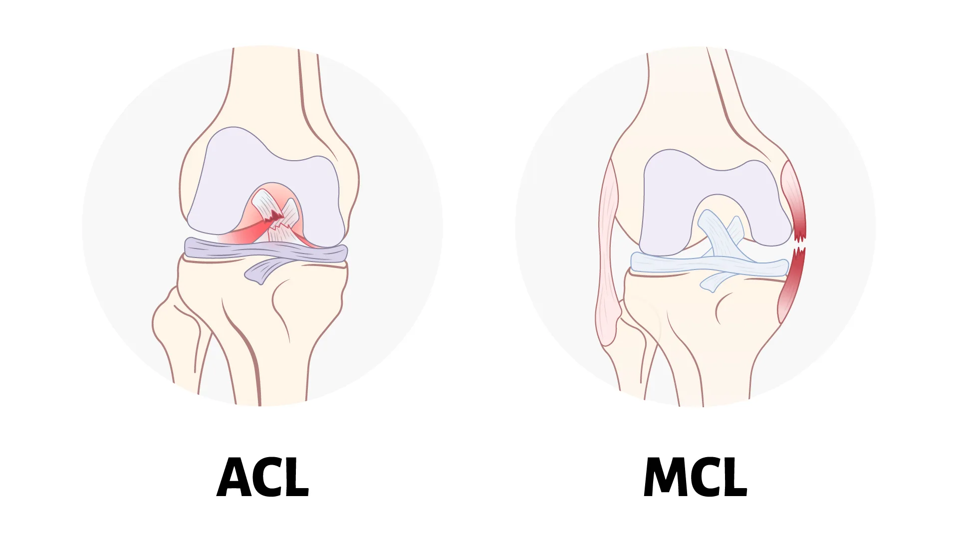 acl and mcl