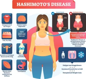 Hashimoto's Disease