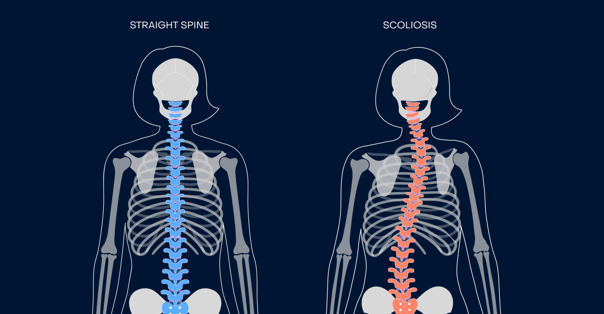 Scoliosis Management